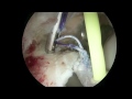 Arthroscopic Hip Labral Reconstruction with Autogenous Iliotibial Band Graft