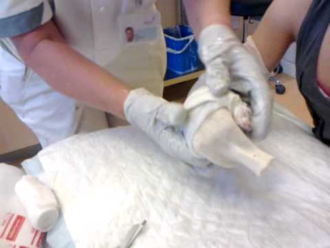 er werd gips gezet :p 2armen :$