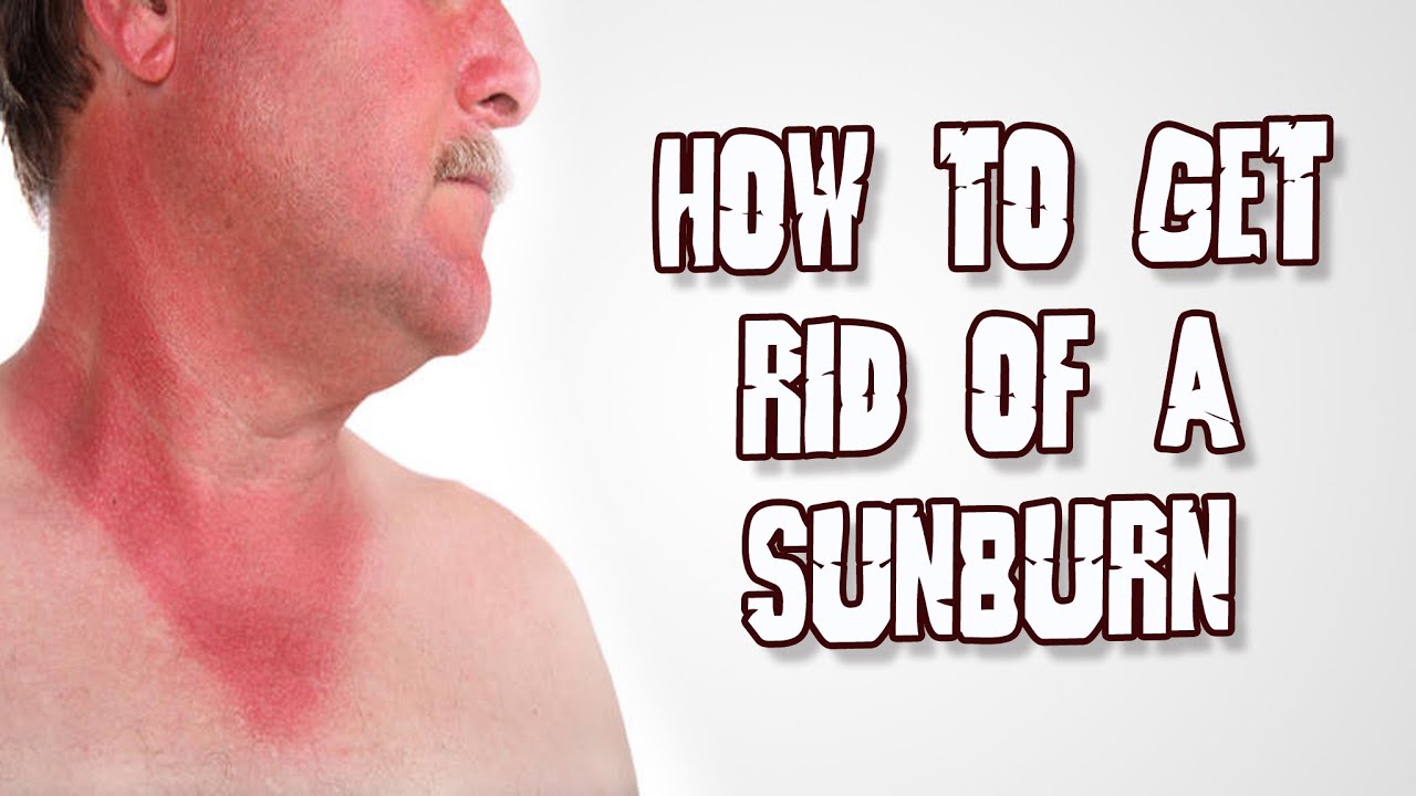 what do you do to get rid of sunburn