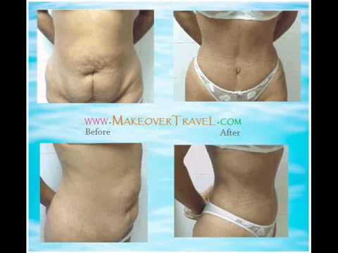 Tummy tuck Before and After of patients who performed a tummy tuck surgery