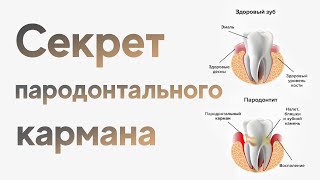 Секрет пародонтального кармана