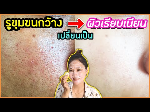 บอกลา "รูขุมขนกว้าง" หน้ามันเยิ้ม แก้ให้ผิวกระชับ เรียบเนียน รวดเร็วที่สุด เห็นผล 100% l สรรหามาทำ
