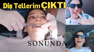 Diş Tellerim Çıktı Retainer, Şeffaf Plak Dönemi...