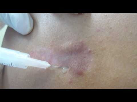 Intralesional steroid injections video