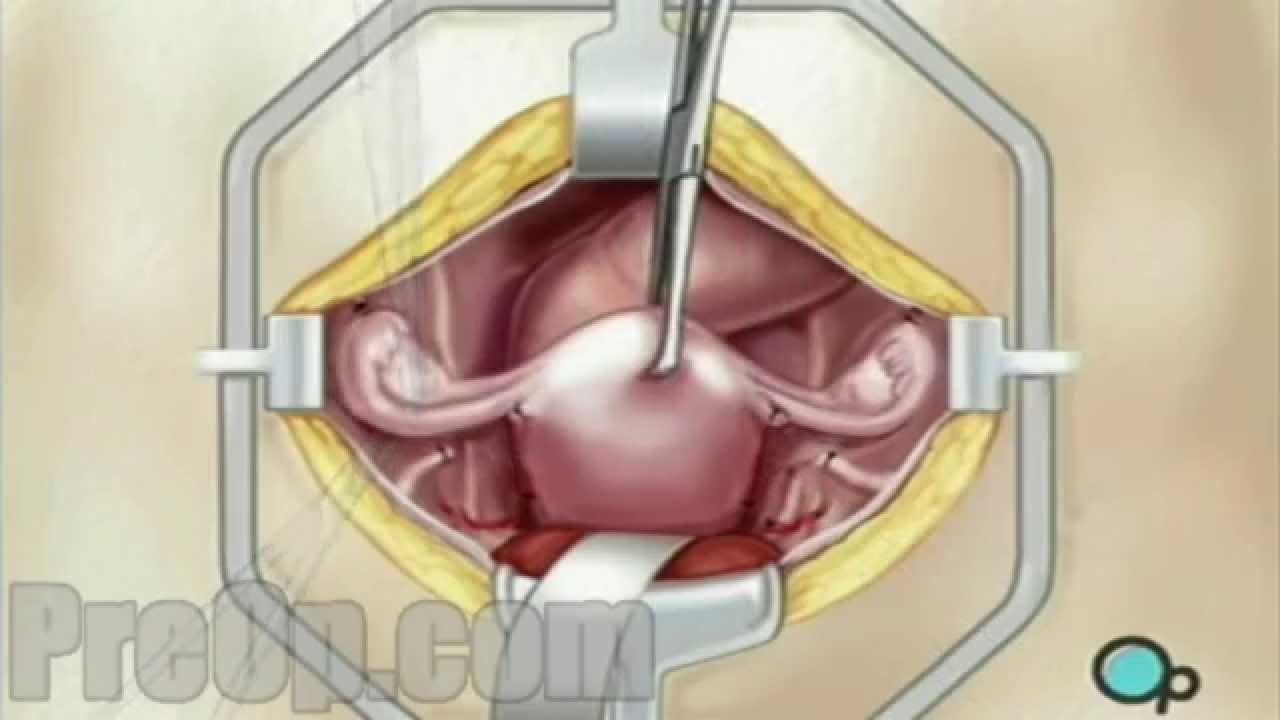 PreOp® Hysterectomy Removal of Uterus, Ovaries and ...