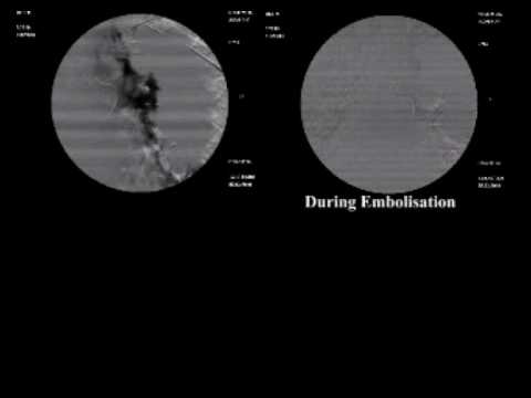 Bronchial Artery Embolisation