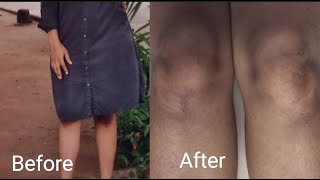 How To Get A Light Knee And Elbow With Just One Product