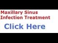 Maxillary Sinus Infection Treatment Best There Is | Sinus Doctor