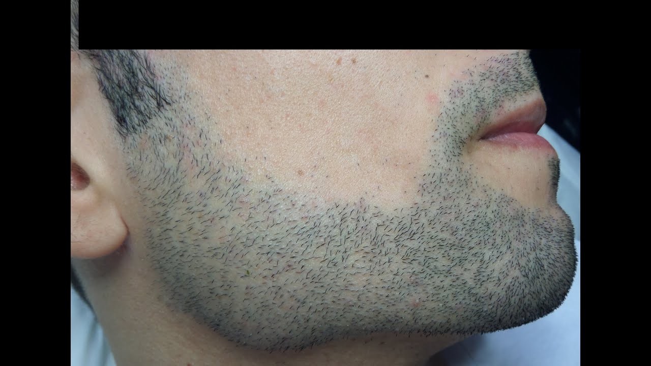 Facial hair labia acne period