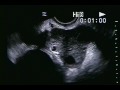 TWINS!!! Ultrasound