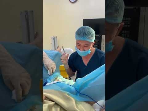 Cắt tạo hình môi bé cho e gái cực xinh 2000 ,Môi bé phì đại. Ngày 28-3-2021..Hotline 0392882888