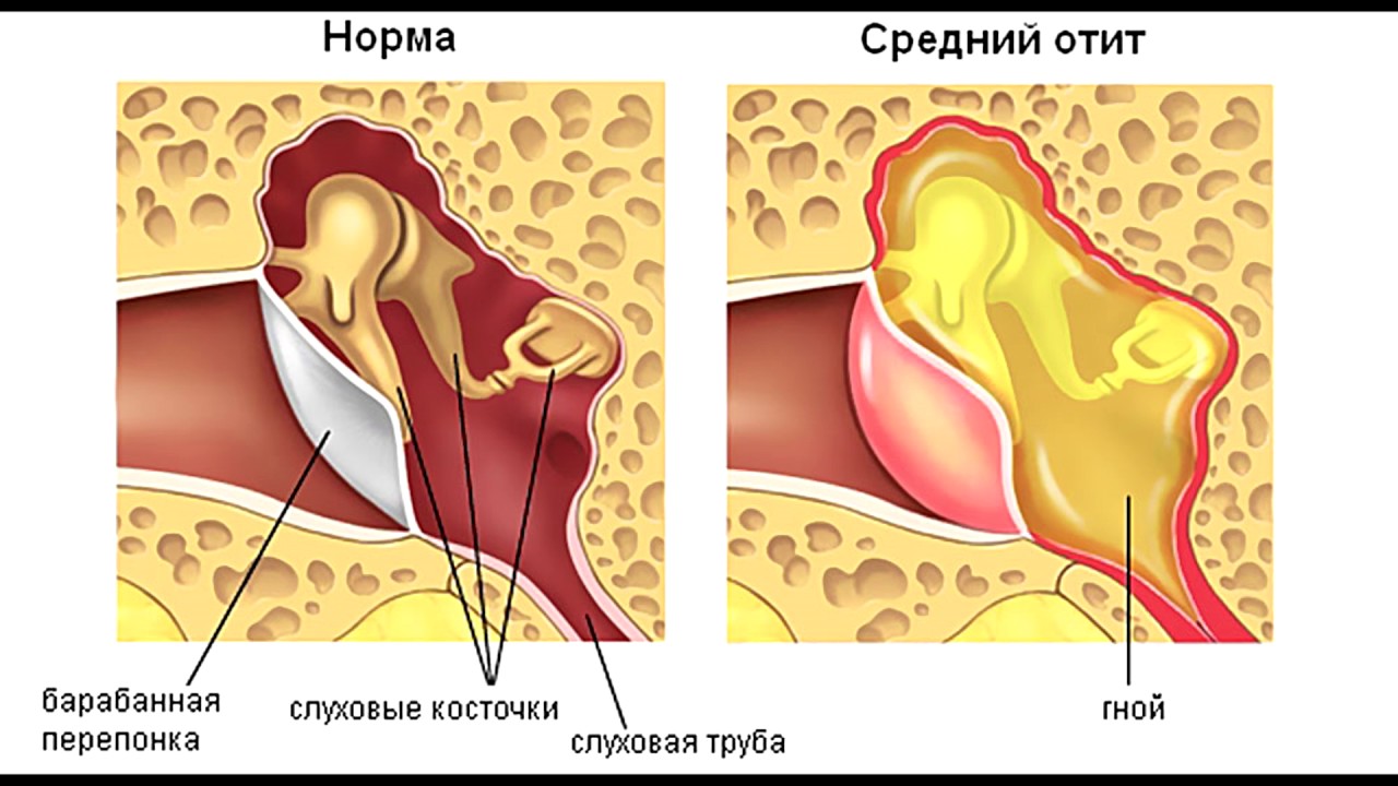 Наружный отит у беременных 49