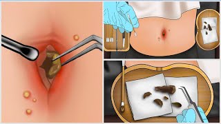 Asmr Remove Huge Navel Stone Animation - 거대한 배꼽 돌 제거 애니메이션
