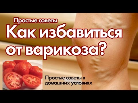 Как лечить варикоз домашнее условиях Как лечить варикоз домашнее условиях