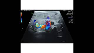 Midgut Volvulus On Ultrasound .