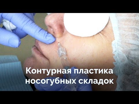 Контурная пластика и коррекция носогубных складок Контурная пластика и коррекция носогубных складок