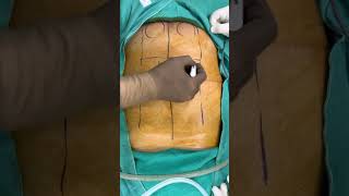 Etep Inguinal Hernia Port Positions. Tep. Enhanced Tep