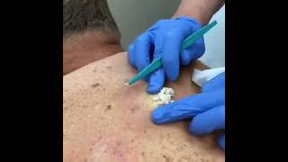 Sivilce Patlatma Videoları Daha Fazlası Youtube Kında