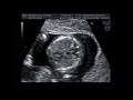 12 weeks - Ultrasound and 3D scan