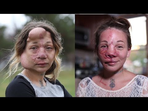Mum Has Medical Balloons Removed From Her Face