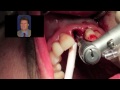 Immediate Dental Implant Surgery  - Dr Scott MacLean