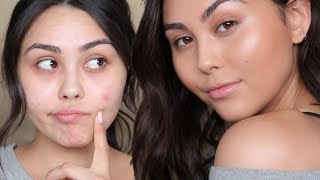 NO MAKEUP MAKEUP LOOK TO COVER ACNE | Roxette Arisa NO MAKEUP MAKEUP LOOK TO COVER ACNE | Roxette Arisa