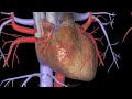 Heart Bypass Surgery (CABG)