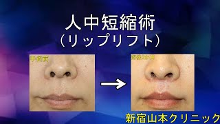 人中短縮術(リップリフト、上口唇短縮術)の50代の女性の変化と経過