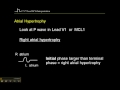12-15 Lead ECG: Atrial Hypertrophy