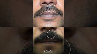 Moustache Hair Transplant Results At Cara