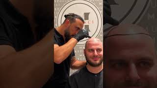 Saç Eki̇mi̇ - Murat Makasci Kli̇ni̇k