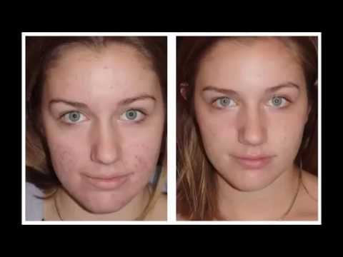 coconut oil acne before scars treatment pimples results using