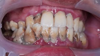 Scaling Pembersihan Karang Gigi Sensor Dokter Gigi Tri Putra