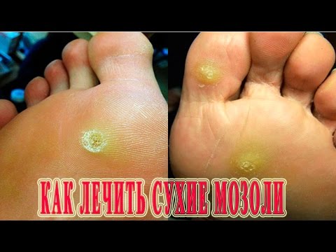 Как лечить натоптыши на ступнях в домашних условиях Как лечить натоптыши на ступнях в домашних условиях