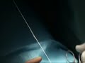 safenectomia