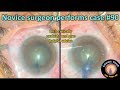evaluation of a novice surgeon performing cataract surgery