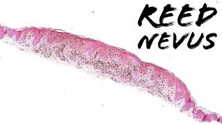 Pigmented Spindle Cell Nevus Of Reed Reed Nevus - Subtype Of Spitz Nevus? Pathology Histology