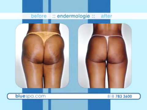 Cellulite Removal | Best Cellulite Treatments