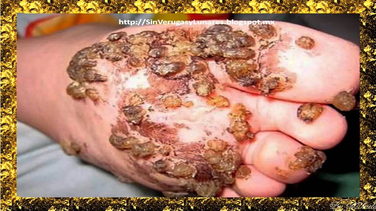 Fotos papiloma humano verrugas genitales 14 Fotos papiloma humano verrugas genitales 34