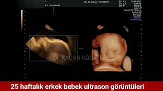 25 haftalık gebelikte ultrasonda erkek bebek nasıl görünür? - Dr Kağan Kocatepe