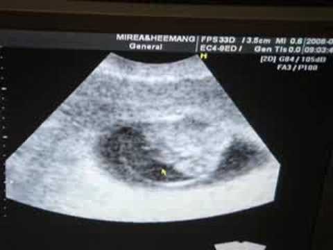 ultrasound 8 weeks. 3rd ultrasound - 8 weeks