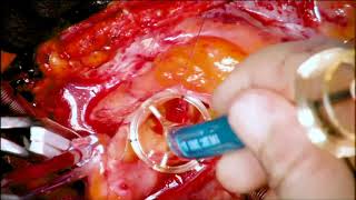 Redo AVR for Paravalvular Leak Following TAVR