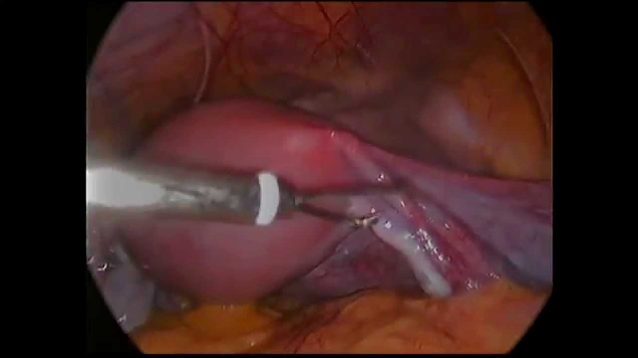 What Is Tubal Ligation What Is Tubal Ligation