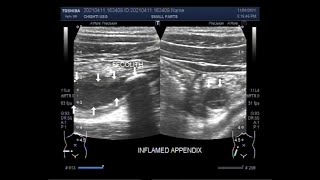 The Diagnosis Of Acute Appendicitis With Fecolith By Ultrasound.