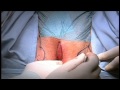 Male Sling / Transobturatorisches Band