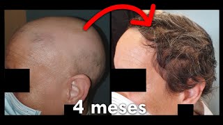 Alopecia areata : JAK