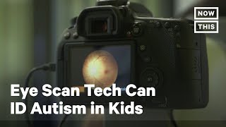 Eye Exam Detects Early Signs Of Autism In Children