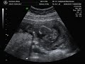 16 week 6 day ultrasound .....it's a boy