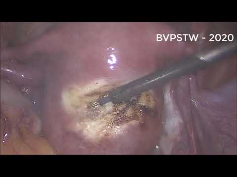 Nội soi bóc u xơ tử cung - BVPSTW 2020