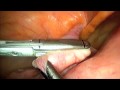 Laparoscopic Supracervical Hysterectomy 18 Weeks Uterus